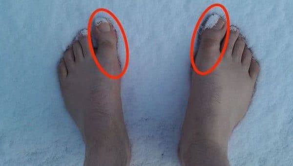 Quelle chaussure pour hallux rigidus ?